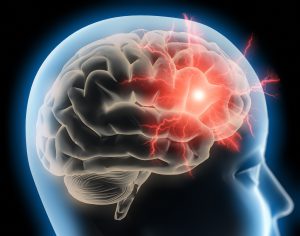 Acupuncture for Migraines & Headaches: A Drug-Free Solution for adults and teenagers: