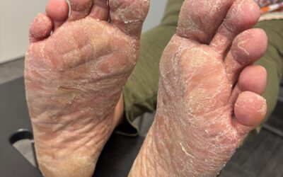 Acupuncture & the Skin: Restoring Balance in Dermatologic Disease